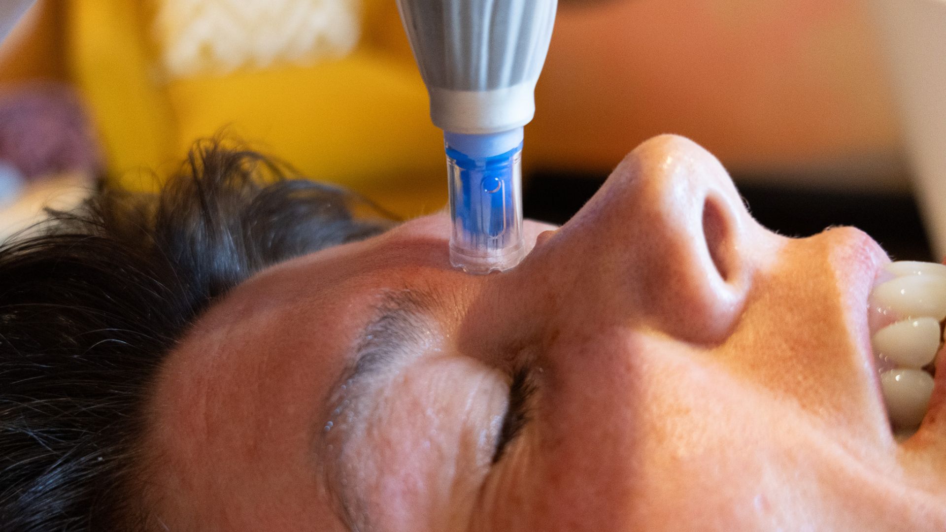 Dermapen Collagen Induction Therapy at Mabin House Nelson